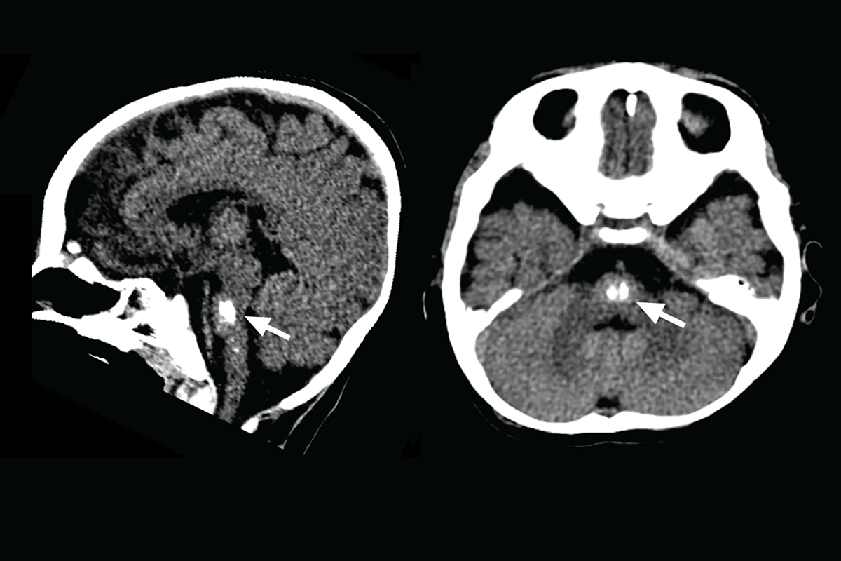A scan of a brain stem showing a pattern of brain calcifications.