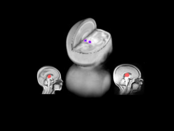 MRI cross section of brain. Two shown in profile, one as a 3D image.