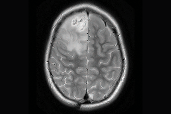 A scan of a brain with priMMRD subtype 1