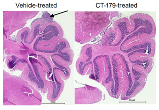 Two side by side stains of a brain tumour, the right showing reduced growth.