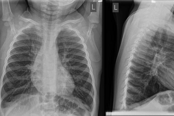 Chest x-ray.