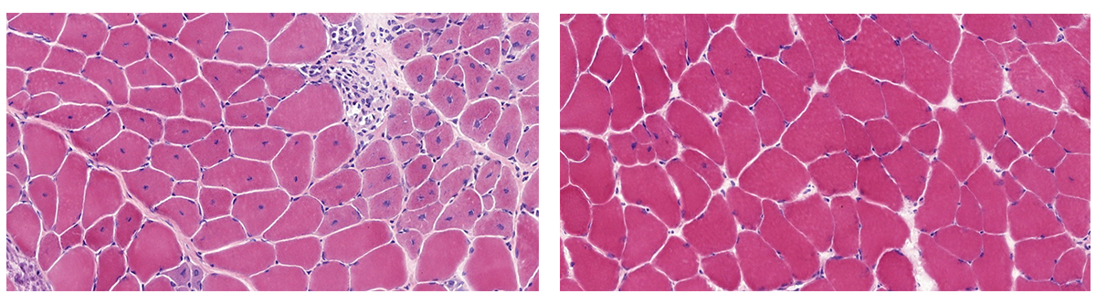 A side-by-side comparison of microscopic images of cells. The cells in the first image are lighter pink with many blue spots and abnormalities throughout, and the cells in the second image are more pink with less abnormalities.